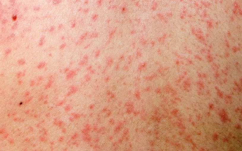 Measles Virus Linked to Morocco Found in Brussels Sewage