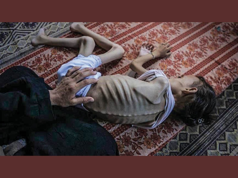 263 starved to death, 62,000 killed and 156,230 wounded in Gaza