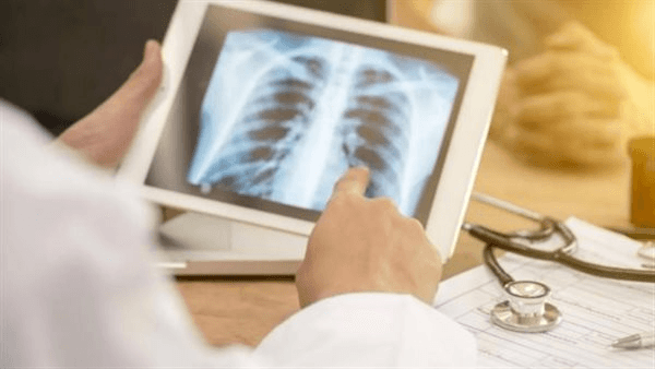 الصحة: أجهزة تشخيصية جديدة تسرّع اكتشاف الدرن وتُحدث نقلة في السيطرة على المرض