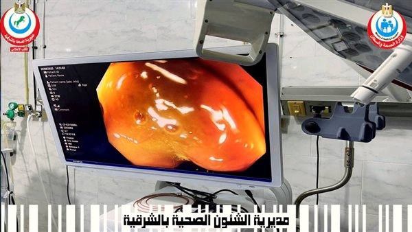 صحة الشرقية: إجراء عمليات متقدمة بوحدة مناظير الجهاز الهضمي بمستشفى منيا القمح باستخدام تقنية الفراغ الثالث