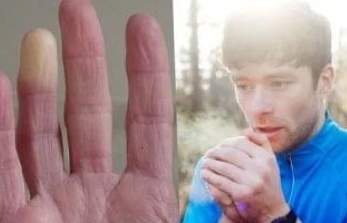 صحة وطب : ما متلازمة رينود المسببة لزرقة الأطراف.. أشهر الأعراض وطرق العلاج