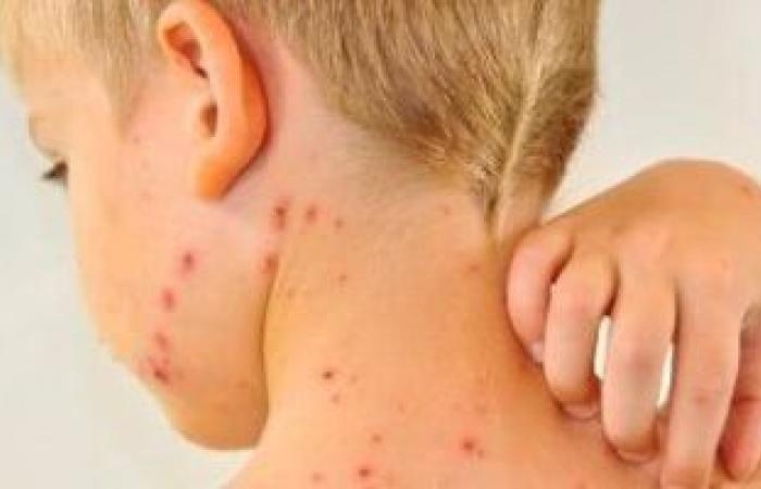صحة وطب : للأمهات.. إزاى تحمى طفلك من الجديرى المائى؟