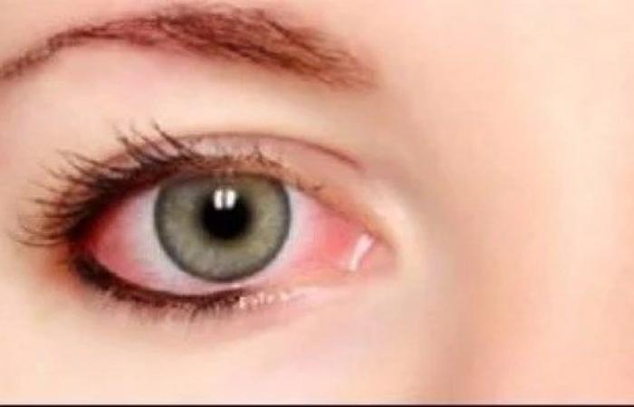 أخبار مصر : انتبه لأعراضه في فصل الزهور.. مرض الربيع يهاجم العيون ويهدد الراحة والرؤية