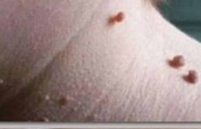 صحة وطب : لماذا يصاب بعض مرضى السكر بالزوائد الجلدية