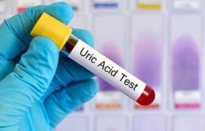 صحة وطب : ارتفاع حمض اليوريك.. 5 أطعمة تجنبها ونصائح للحفاظ على صحة الكلى