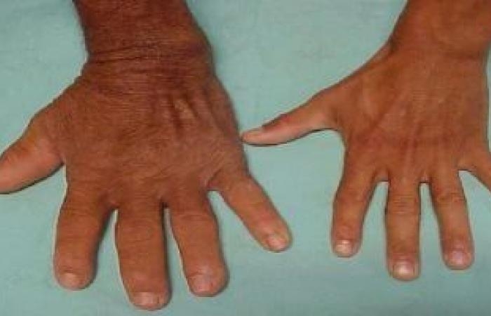 صحة وطب : كل ما يجب أن تعرفه عن اضطراب ضخامة الأطراف