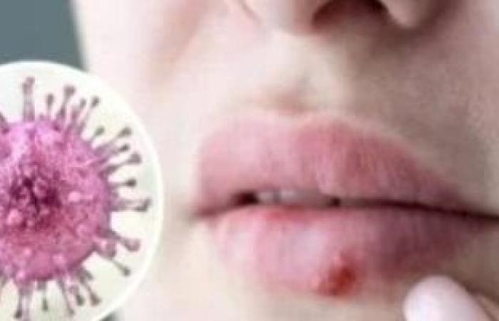 صحة وطب : ماذا تعرف عن فيروس إبشتاين بار.. وكيف يعزز انتشاره داخل الجسم