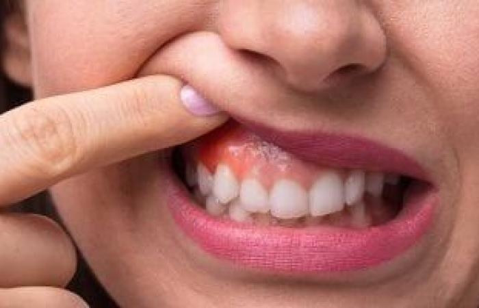 صحة وطب : المصابون بقروح الفم أكثر عرضة مرتين بارتفاع ضغط الدم