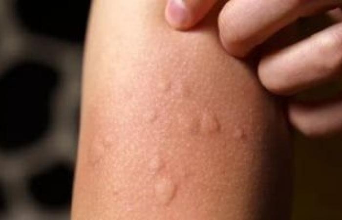 صحة وطب : شديدة الندرة وتسبب طفح جلدى مؤلم عند الاستحمام.. ما هى حساسية الماء؟