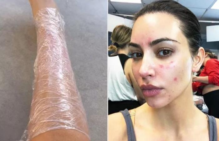 صحة وطب : مرض جلدي مناعى تعانى منه كيم كاردشيان يجعلها تغلف جسمها بالبلاستيك