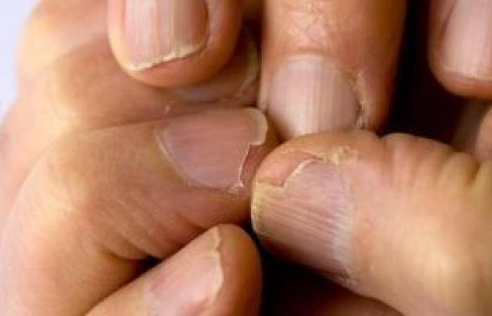 صحة وطب : أمراض تكشفها الأظافر الزرقاء