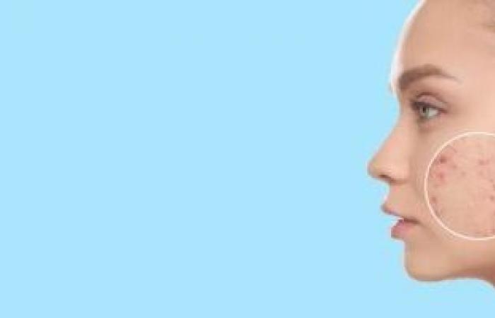 صحة وطب : أسباب ظهور حب الشباب فى الرقبة.. كيف تتخلص منه