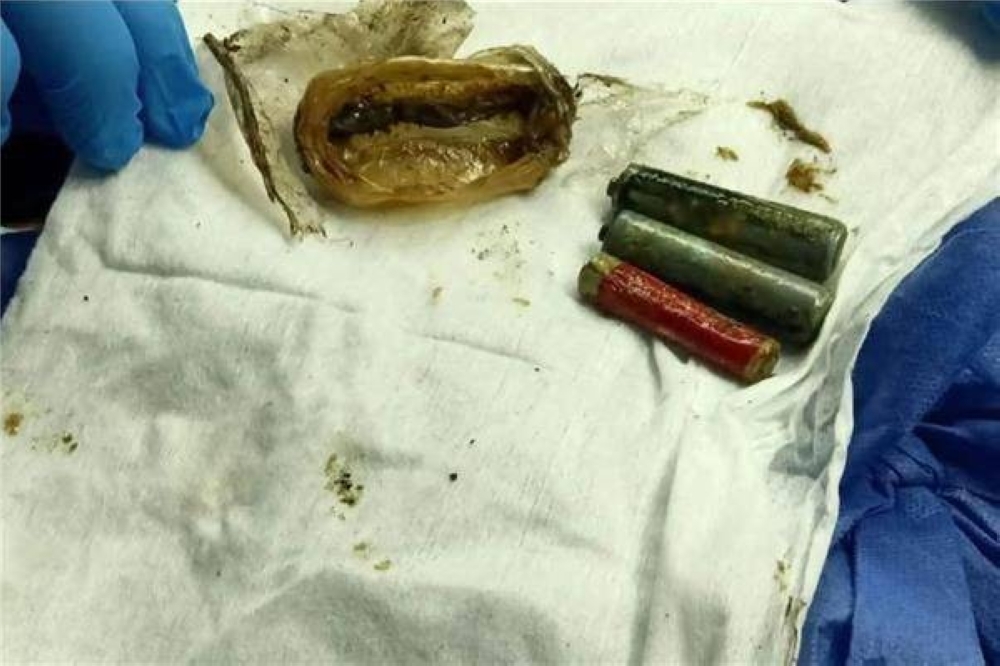 استخراج 3 بطاريات عالقة في معدة مريض لأكثر من عام ونصف
