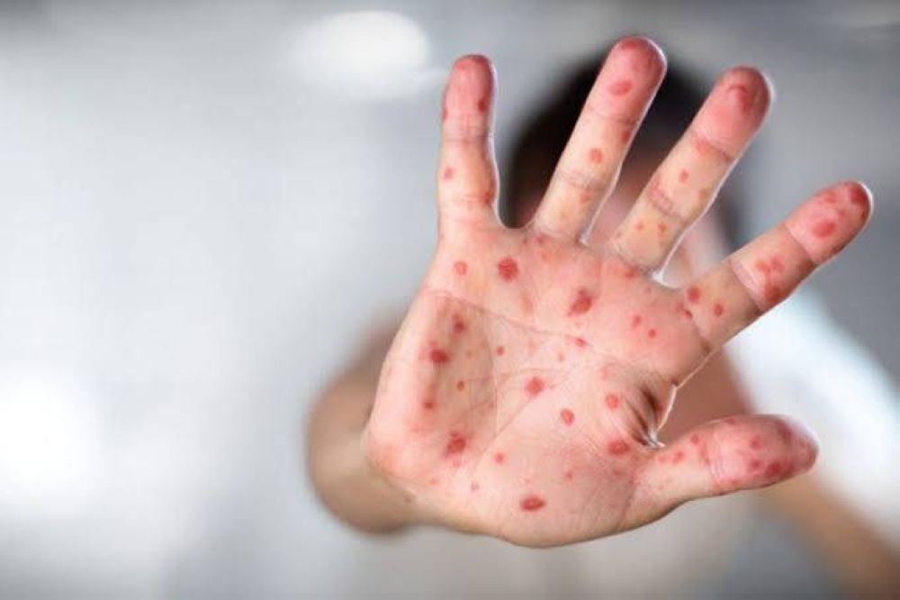 من لندن إلى تل أبيب.. «الحصبة» تضرب قلب إسرائيل