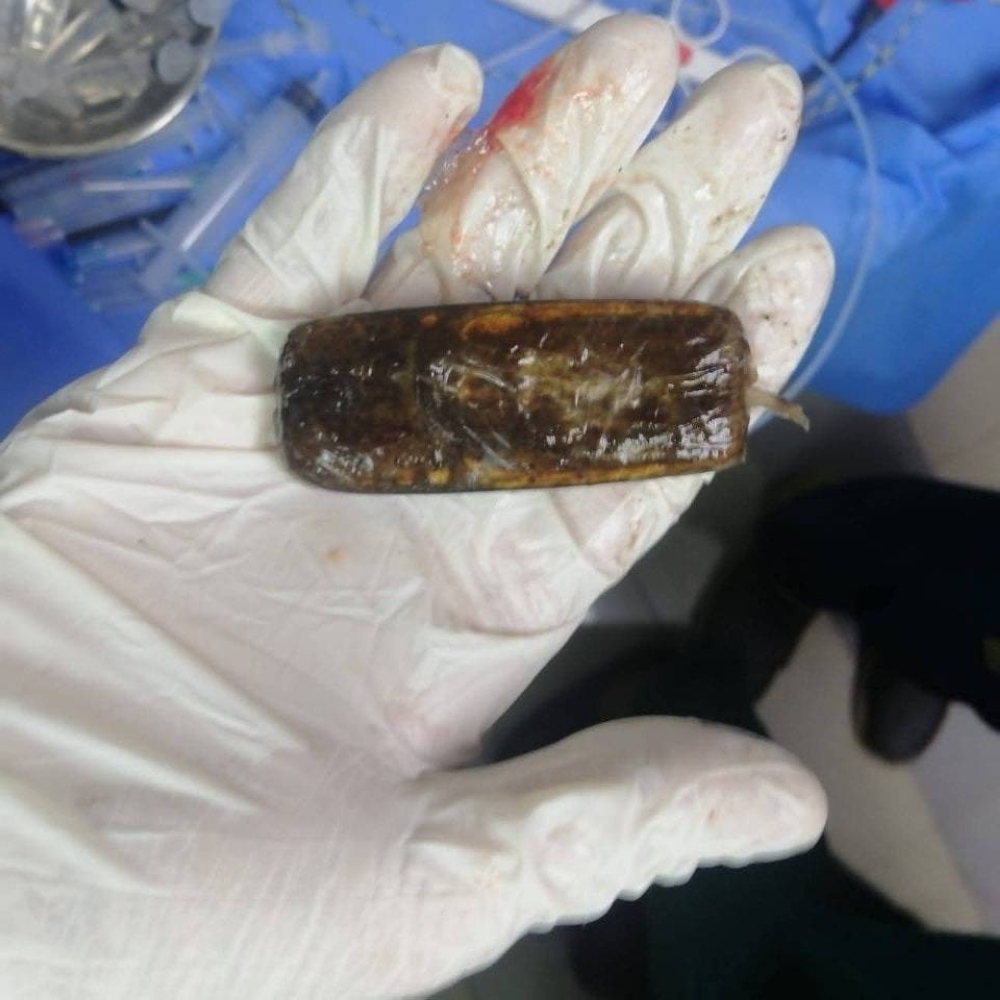 في واقعة نادرة.. استخراج هاتف محمول من بطن شاب مصري بعد عامين من ابتلاعه