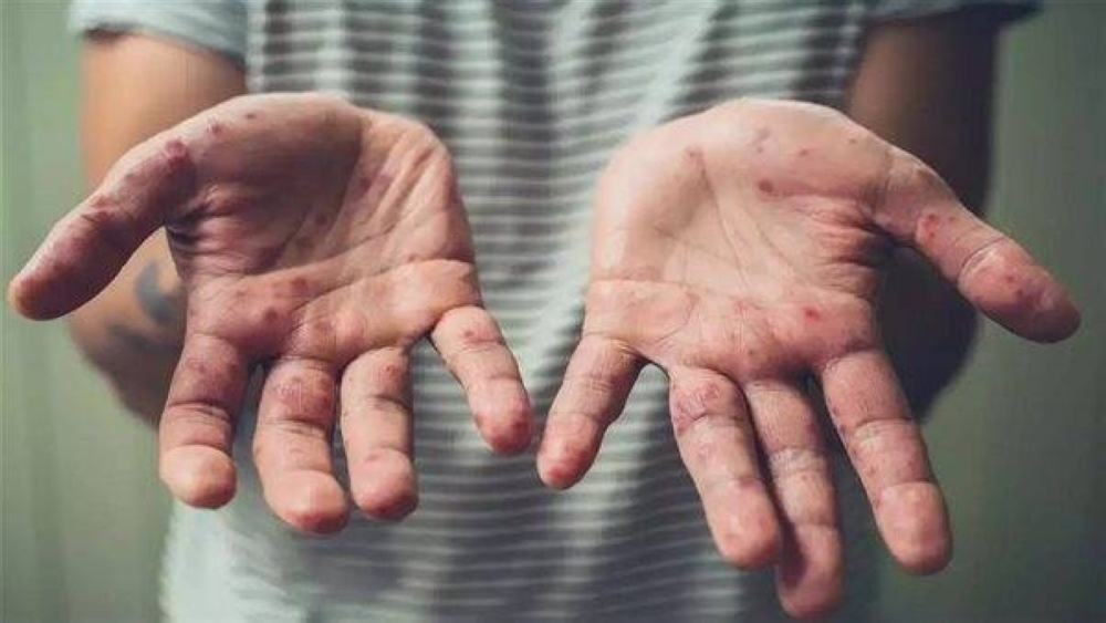 غينيا تواجه موجة جديدة.. 18 إصابة بجدري القردة تثير القلق الصحي