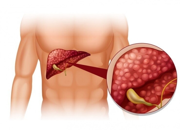 Liver cancer to double worldwide, but preventable: Study