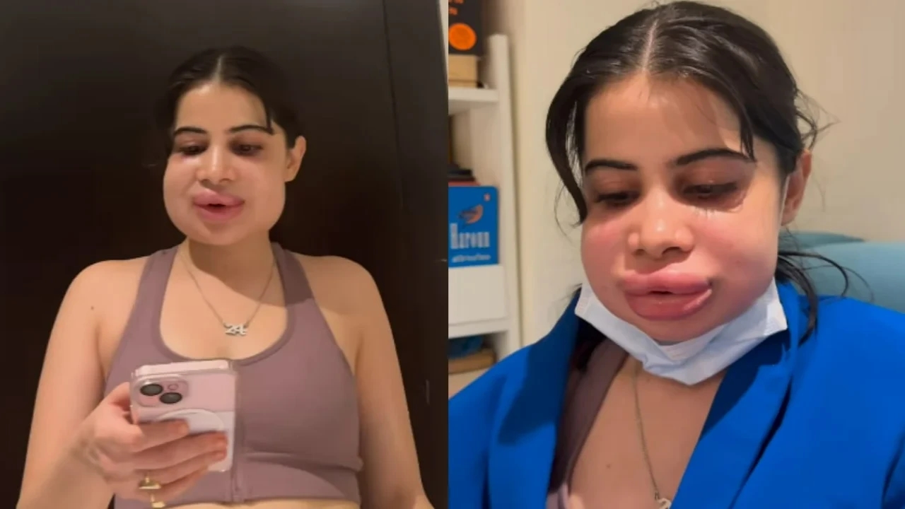 'My boyfriend told me...' Uorfi Javed drops new VIDEO after her lip filler dissolving procedure, netizens REACT
