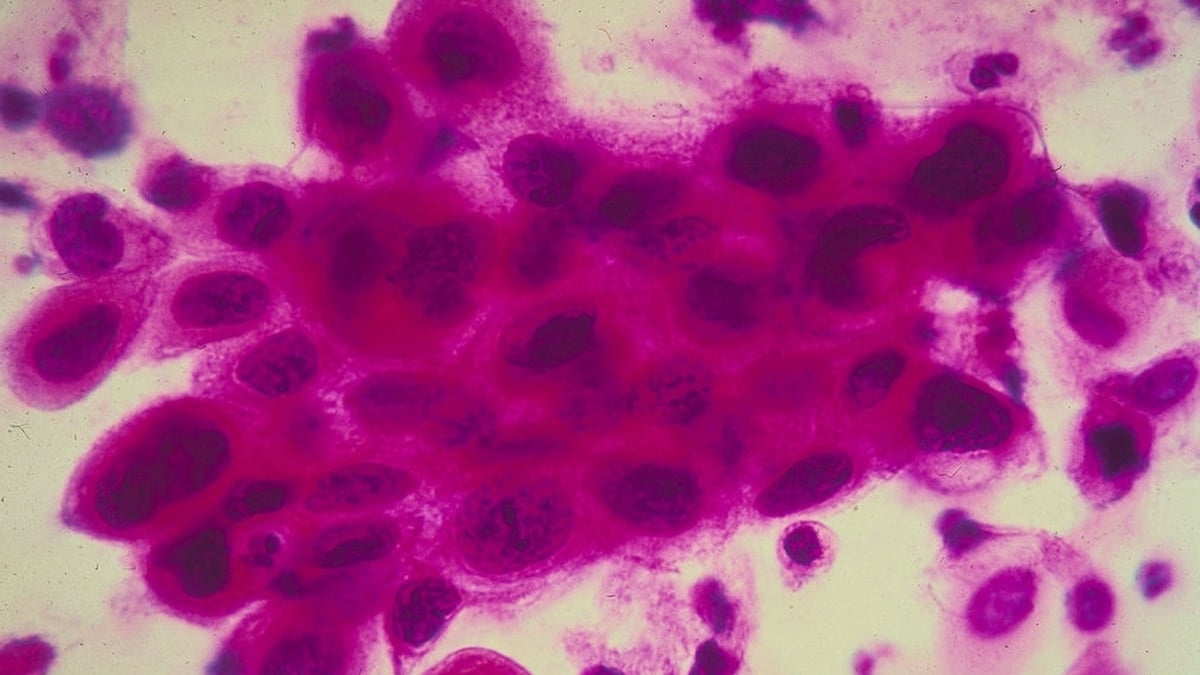 New exhibition examines the evolution of cancer