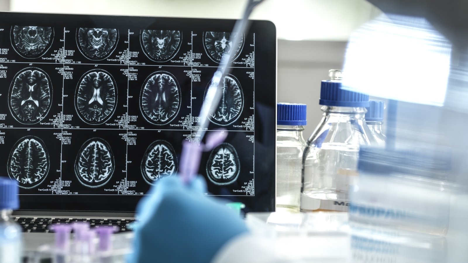 'Hope on horizon' as new drugs tested for Alzheimer's treatment