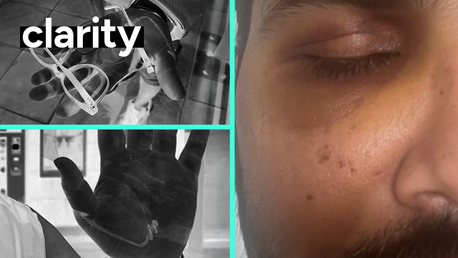 Assault victim links attack to racism and rise in misinformation