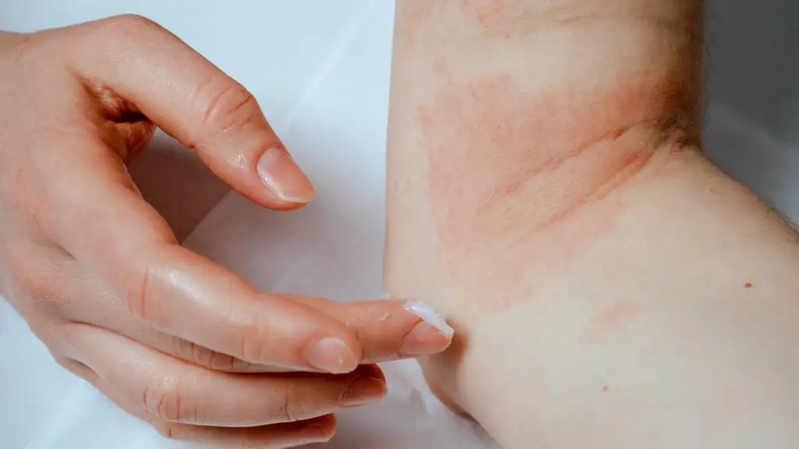 Psoriasis-friendly skincare routine