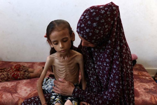 Children of Gaza: Emaciated Bodies, Sunken Eyes, and Lives Ravaged by Zionist Starvation