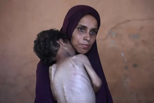 3 new deaths raise death toll from famine, malnutrition in Gaza to 269 martyrs