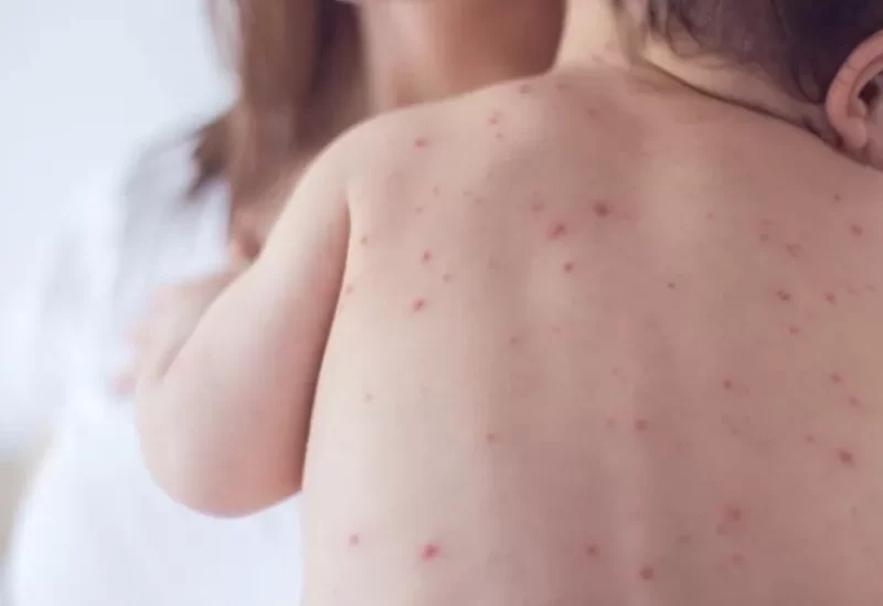 أميركا.. ارتفاع حالات الإصابة بالحصبة في تكساس إلى 683 حالة
