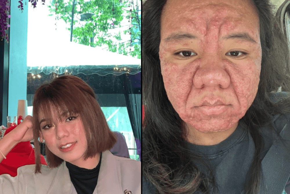 The skin I didn't expect: The extreme facial changes this mum faced during pregnancy