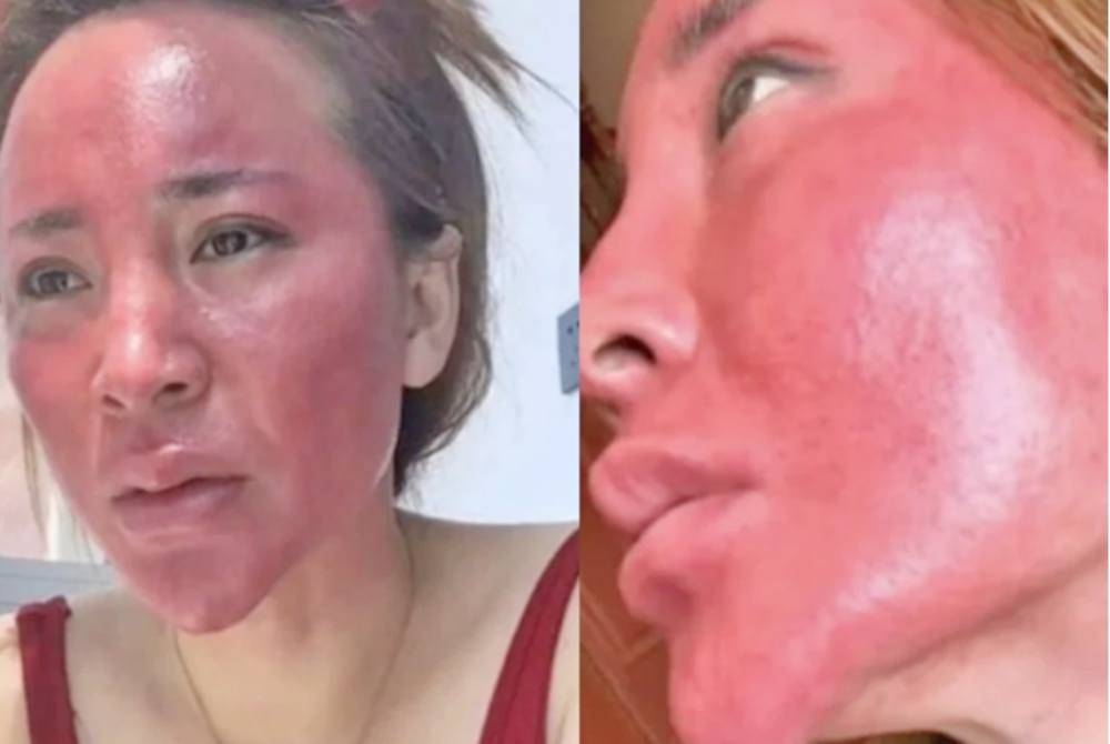 Woman's face severely swells, infected after skipping proper makeup removal for 22 years