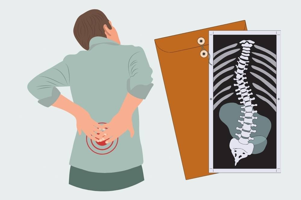 Not just bad posture: The hidden toll of scoliosis on health and life