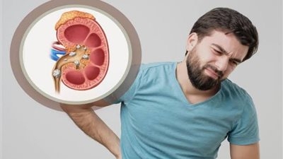 4 علامات تشير إلى تفاقم مرض الكلى .. افحص نفسك