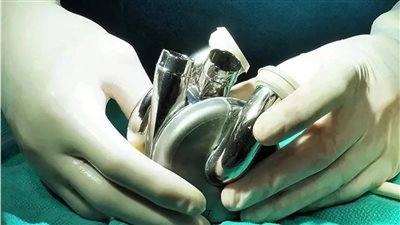 «إنجاز طبي تاريخي».. أول مريض في العالم يغادر المستشفى بقلب اصطناعي كامل في أستراليا