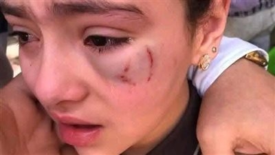 تصالح بين أسرة الطفلة 'حنين' والمعلم بعد إصابتها في عينها داخل مدرسة بالدقهلية