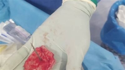 إنجاز طبي نادر بجامعة الفيوم: استخراج مسمار من جمجمة طفل دون إصابة المخ