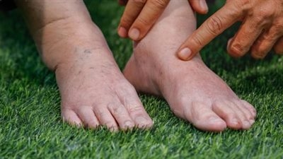 أبرز المشروبات الطبيعية للتخلص من حصوات الكلى وطرد الأملاح بفاعلية