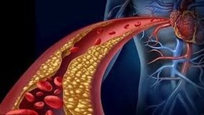 5 فواكه تقاوم الكولسترول وتعزز صحة القلب