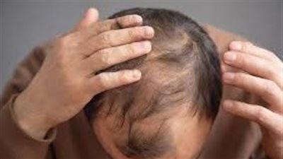 السكر والصلع.. دراسة تربط بين مشروبك المفضل وفقدان الشعر