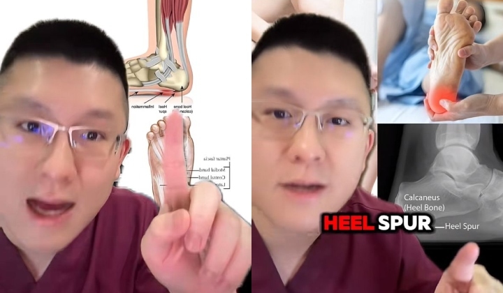 TikTok Doc Kenneth Wong Highlights Heel Spurs