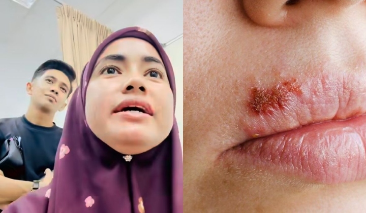 Entrepreneur 'Kieda Crepe' Shares Her Oral Herpes Diagnosis – Doctor On Twitter Weighs In