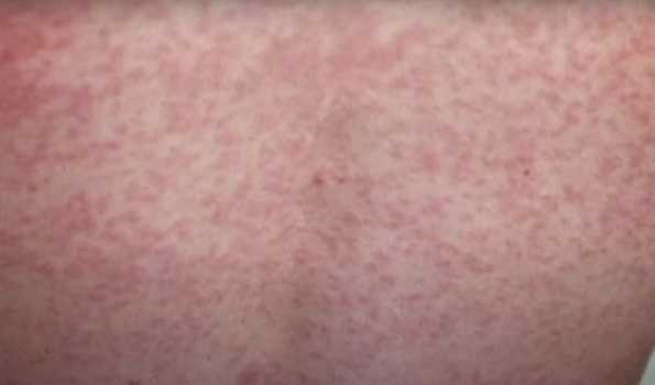 Measles health alert issued for Australian state of Victoria
