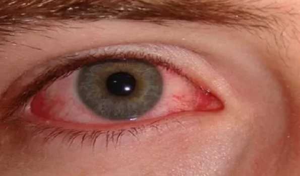 Surge in pink eye conjunctivitis cases in Kerala
