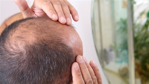 أسباب تساقط الشعر المبكر لدى الرجال وطرق علاجه بالمنزل