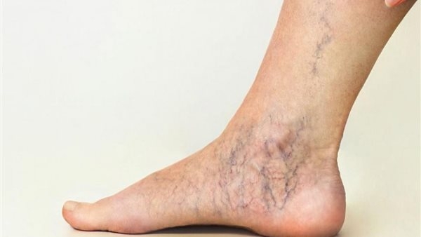 طرق علاج دوالي الساقين بالمنزل وأسباب ظهورها المختلفة