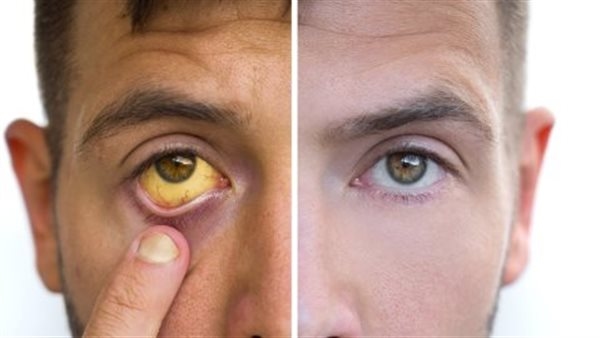 أعراض الصفراء لدي البالغين وطرق علاجها المختلفة