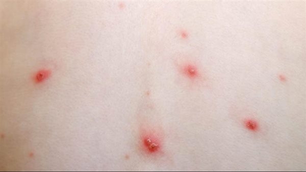 أعراض الجديري المائي وأسبابه