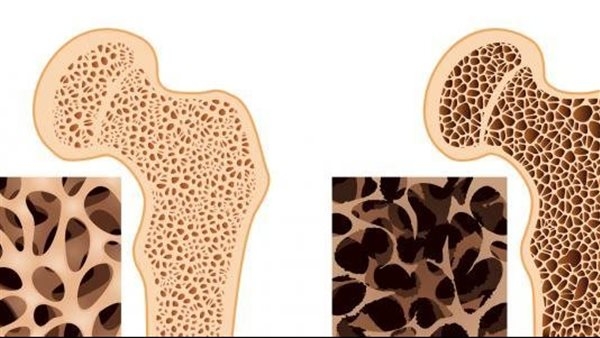 أعراض وأسباب هشاشة العظام وطرق العلاج والوقاية