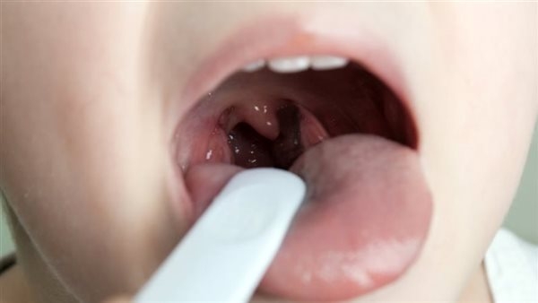 أعراض التهاب اللوزتين عند والأطفال وطرق التعامل معه
