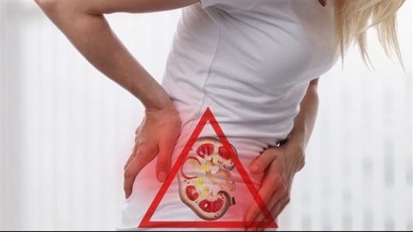 حصوات الكلى، أسبابها وأعراضها وطرق العلاج والوقاية